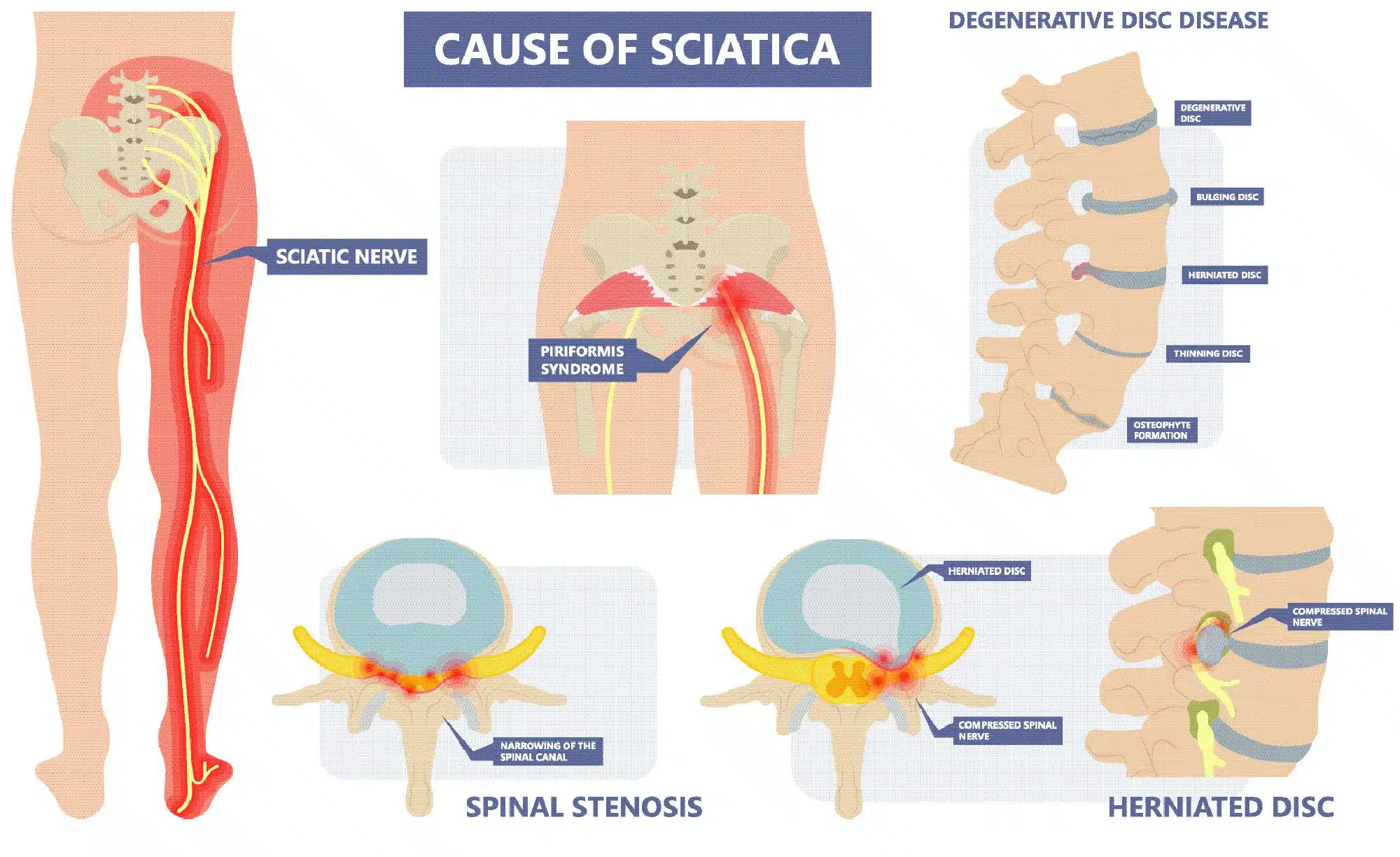 Uncovering the Mystery of Sciatica! - Sports Therapy One